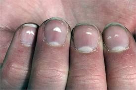 Белые пятна на ногтях пальцев рук - причины