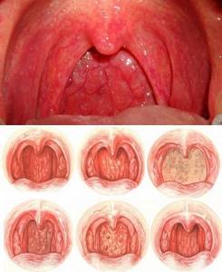 Волдыри в горле: причины, лечение, красные и белые волдыри у ребенка на задней стенке и языке