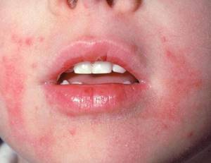 Как вылечить дерматит у детей