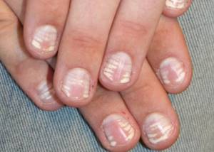 Белые пятна на ногтях у ребенка