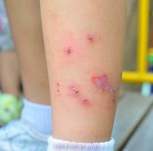 Детский дерматит: аллергический, атопический, себорейный