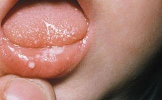 Белый волдырь на внутренней стороне губы у новорожденного ребенка, лечение