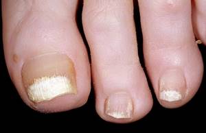 Белые пятна на ногтях ног