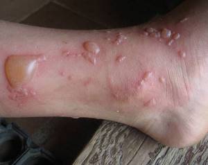 Появились волдыри на ступнях ног: причины и лечение, водянистые волдыри у ребенка