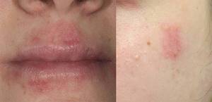 Лечение себорейного дерматита на лице