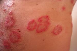 Красные пятна на бедрах: шелушащиеся, не чешутся, у женщин и ребенка