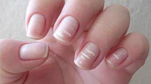 Почему на ногтях появляются белые пятна?