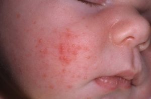 Причины дерматита у детей и взрослых
