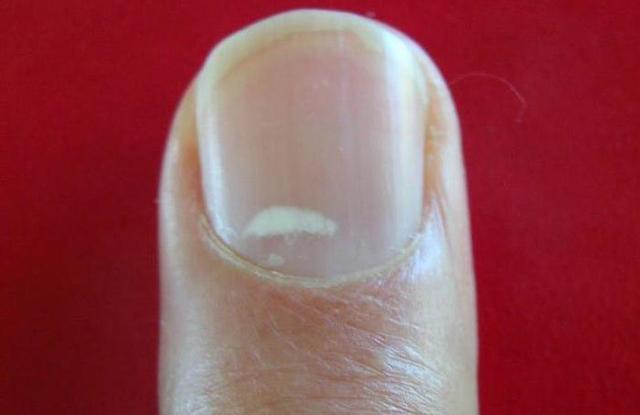 Белые пятна на ногтях пальцев рук