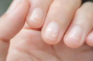 Почему на ногтях появляются белые пятна?
