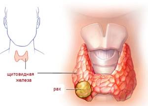Фолликулярная опухоль щитовидной железы: симптомы, прогноз и лечение