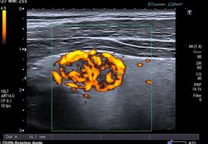 Допплерография щитовидной железы - диагностика болезней органа