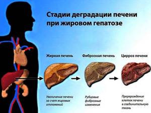 Жировой гепатоз печени: симптомы и лечение гепатоза, диета