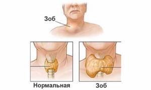 Фокальные изменения щитовидной железы: причины и лечение