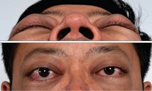 Глазные симптомы диффузного токсичекого зоба (тиреотоксикоза). Причины, патогенез и лечение глазных симптомов тиреотоксикоза