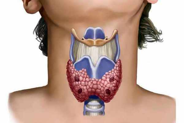 Что такое фолликулы щитовидной железы и опасны ли они для здоровья человека?