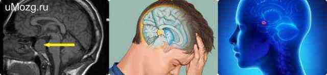 Увеличение гипофиза головного мозга: причины и симптомы
