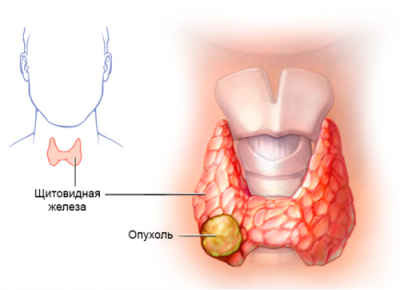 Все 3 онкомаркера щитовидной железы и их нормы
