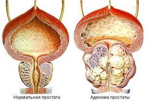 Чем опасна аденома простаты или предстательной железы у мужчин