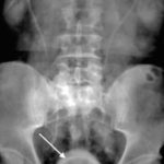 Диффузная гиперплазия предстательной железы - что это такое?