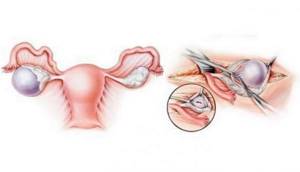 Цистэктомия яичника: что это, способы проведения, последствия
