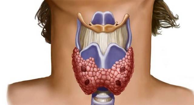 Заболевания щитовидной железы: симптомы и признаки болезни