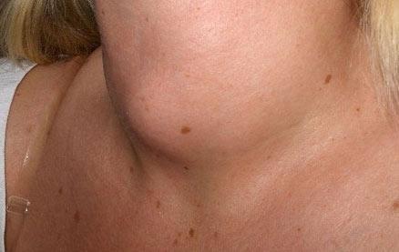 Узлы на щитовидной железе: чем опасны, их размеры, диагностика, лечение, фото