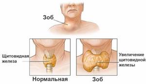 Диффузные изменения щитовидной железы: симптомы и лечение