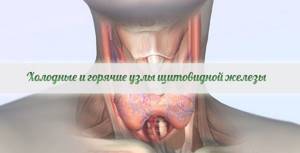 Холодный и горячий узел щитовидной железы: нужна ли операция для их лечения