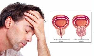 Чем опасна аденома простаты или предстательной железы у мужчин