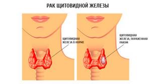 Рак щитовидной железы. Симптомы, признаки, причины, диагностика и лечение заболевания
