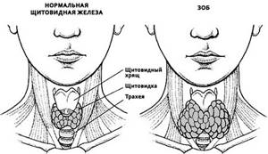 Гипертрофия щитовидной железы: что это такое?