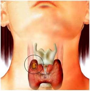 Киста щитовидной железы: причины, симптомы. Как лечить кисты щитовидной железы