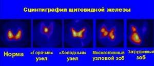 Сцинтиграфия щитовидной железы: что это такое и как проводится