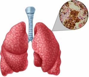 Туберкулез простаты: симптомы и пути заражения, как лечится, и какие анализы сдавать