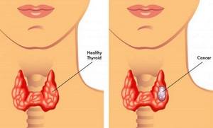 Киста щитовидной железы: причины, симптомы. Как лечить кисты щитовидной железы