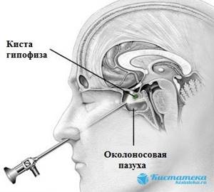 Киста гипофиза головного мозга: симптомы, лечение и последствия