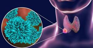 Папиллярный рак щитовидной железы - причины, симптомы, диагностика и лечение