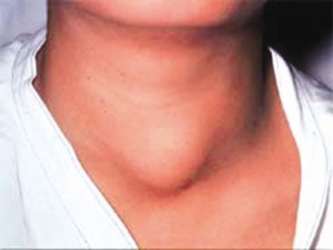 Что такое соноэластография щитовидной железы