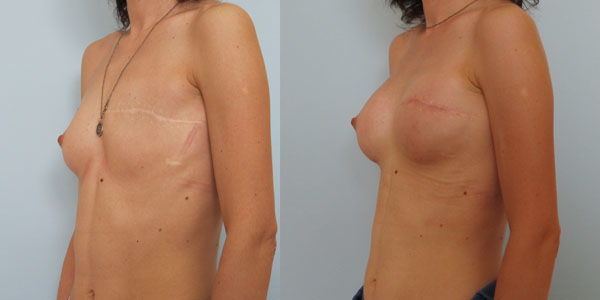 Мастэктомия: методы проведения, осложнения, пластика груди после операции