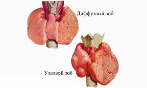Диффузно-узловая гиперплазия щитовидной железы: лечение и симптомы
