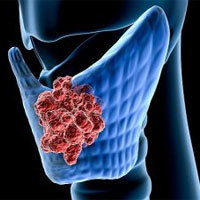 Анапластический рак щитовидной железы - причины, симптомы, диагностика и лечение