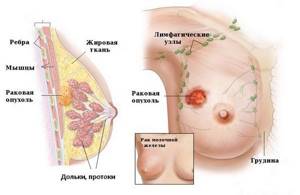 Инфильтративный рак молочной железы: формы заболевания, прогноз выживаемости, лечение