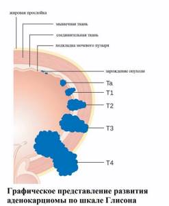Шкала Глисона при раке предстательной железы