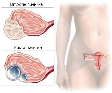 Цистэктомия яичника: что это, способы проведения, последствия