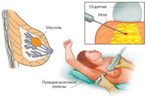 Пункция молочной железы: методы проведения, информативность, восстановление