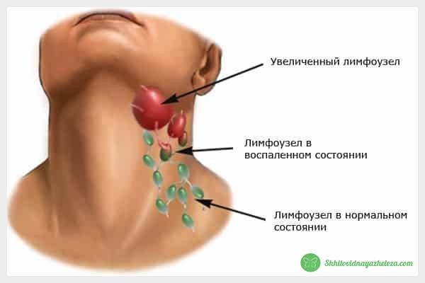 Лимфоузлы и щитовидка: связаны ли они между собой?