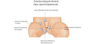 Удаление яичек у мужчин при раке предстательной железы