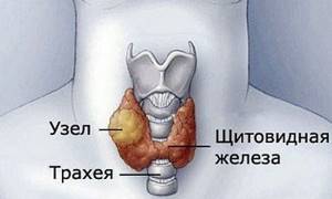 МРТ щитовидной железы: что показывает, показания, подготовка