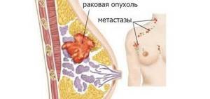 Карцинома молочной железы: классификация, факторы риска, диагностика, лечение